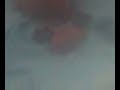 EMBARAZO ECTOPICO CERVICAL