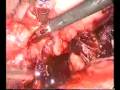 laparoscopic treatment of endometriosic ovarian cyst