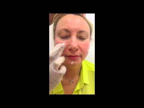 how to cure rosacea redness