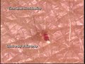 Bed bugs Bed bugs