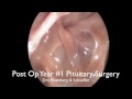 Follow up after Endoscopic Pituitary Surgery Follow up after Endoscopic Pituitary Surgery