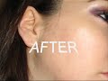 Acne Before and After