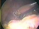 腹腔鏡膽囊摘除術(LC)PART II