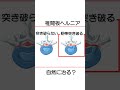 椎間板ヘルニア 自然に治る？ 治るまでの期間は？ 【医師が解説】 #坐骨神経痛 #脊柱管狭窄症 #椎間板ヘルニア