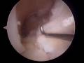 ZR Dr. Vangsness ACL surgery Part 3