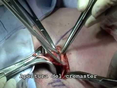 hernioplastia - Técnia de Gilbert con Ultrapro Hernia System UHS y anestesia local, en paciente con hernia inguinal indirecta derecha Dr. Juan C. Mayagoitia León Gto. México.