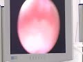 TURP-Prostate-Operat