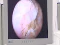 TURP-Prostate-Operat