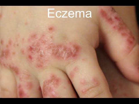 how to stop eczema from spreading