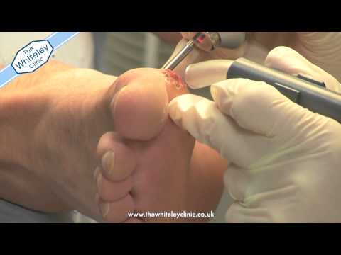 how to treat verruca