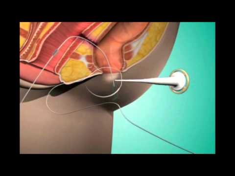 how to cure fistula