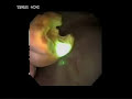 Minimally Invasive Kidney and Ureteral Stone Surgery Minimally Invasive Kidney and Ureteral Stone Surgery