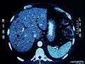 Doctors Try Suffocating Stubborn Tumors