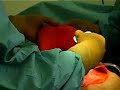 Spray PRP after Abdominoplasty