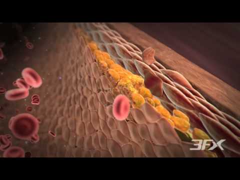 Diabetic Peripheral Arterial Disease (P.A.D.)
