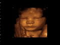 Ultimate Ultrasound at Fetal Vision