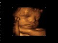 Ultimate Ultrasound at Fetal Vision