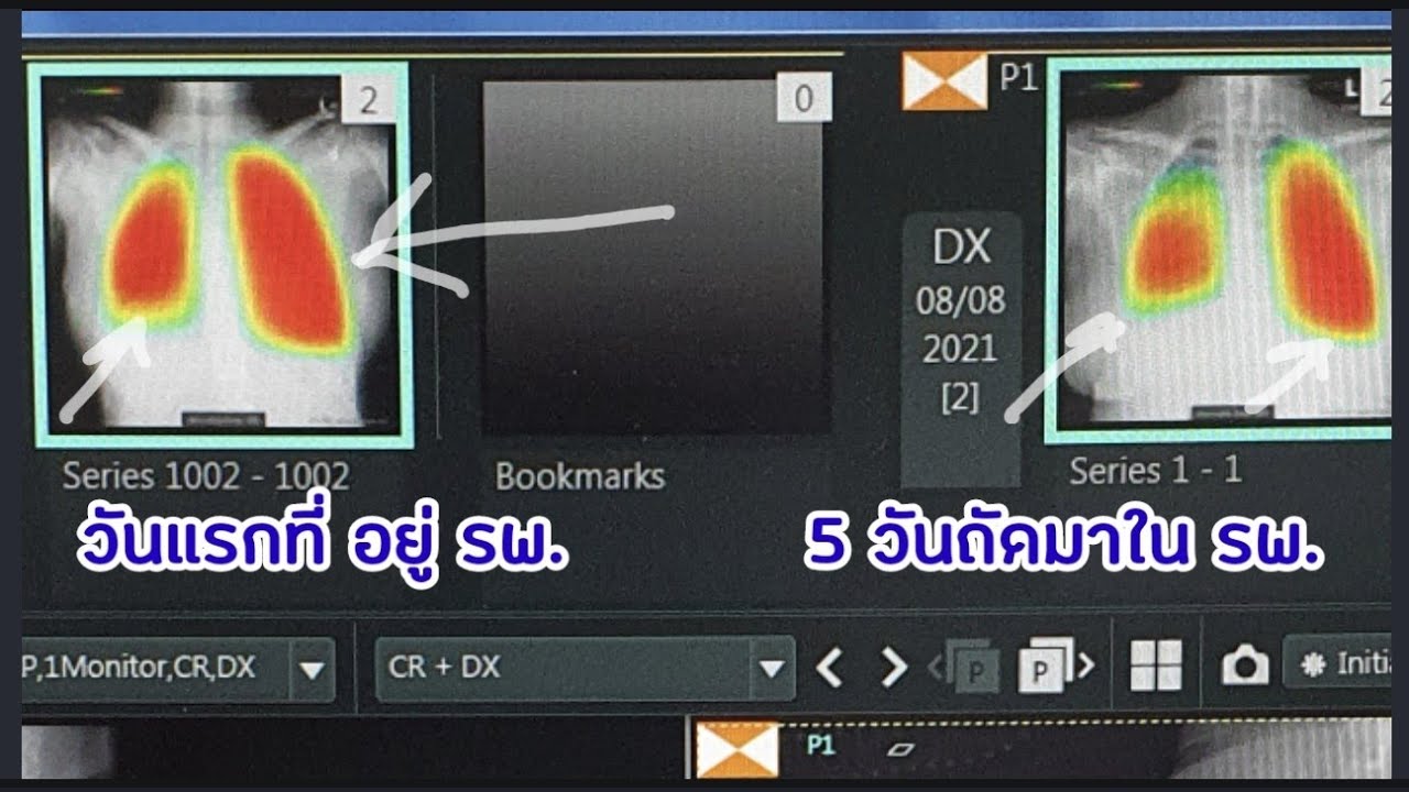Covid EP 94: AI ต่อการดูโควิดลงปอด และอาการหลังโควิด