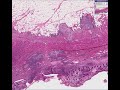 Histopathology Small intestine-- Crohn disease