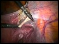 Histerektomi Ameliyatı Prof Dr Bülent Urman www.bulenturman.com