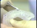 Delivering and Adjusting the Occlusal Bite Plane Splint