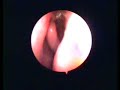 Endoscopia naso sinusale effettuata dal Dott. F.Giangregorio Endoscopia naso sinusale effettuata dal Dott. F.Giangregorio