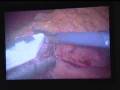 videos de Gastric Bypass Surgery