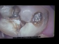 Large decay behind amalgum leading to crown