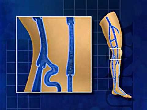 how to test for venous leak