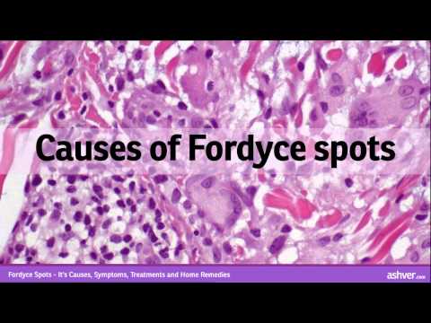 how to get rid fordyce spots