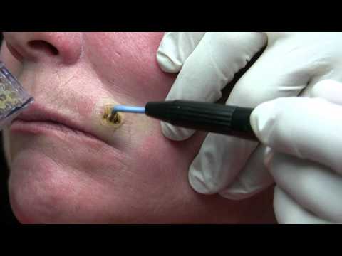 how to remove a mole