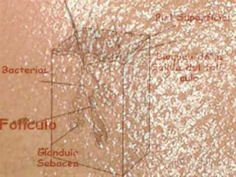 Como se forman las espinillas - Que es el acne - Como acabar con tu acne