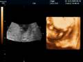 Willem Geirnaert echo -24 weeks