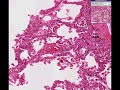 Histopathology Lung --Chronic pulmonary congestion