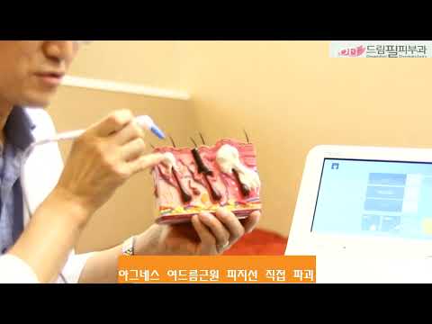 아그네스 여드름의 원인이 되는 피지선 제거하기