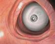 Aer-O-Scope - How does the procedure work?
