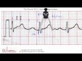 ECG Interpretation, Interval Practice, Part 6-5