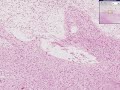 Histopathology, Brain --Cerebral infarct, recent