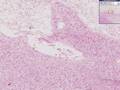 Histopathology, Brain --Cerebral infarct, recent