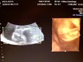ECOGRAFIA BEBE ALAYZA ARCA ECOGRAFIA BEBE ALAYZA ARCA