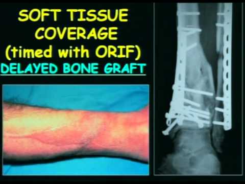 Presentation from the 2010 Trauma Summit in Seattle: Salvaging Severe Pilon Fractures