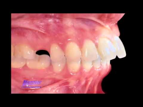 how to cure overbite