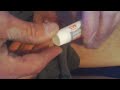Wheelchair style - Nasty Deep 2nd Degree Burn & healing this wound (Part 7) - L1 injury 4-16-12