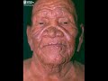 Esse video mostra a realidade sobre a hanseniase, por isso que nele contem foto fortes, mais não deixem de ver até o final. No video mostra uma pequena demostração sobre O QUE É, LUGARES MAIS PROVAVEIS DE SE PEGAR, FOTOS e etc..