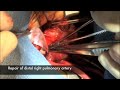 Truncus Arteriosus, Reoperation after Neonatal Stents Truncus Arteriosus, Reoperation after Neonatal Stents