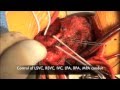 Truncus Arteriosus, Reoperation after Neonatal Stents
