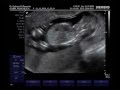 Ultrassonografia morfol�gica! 14 semanas!