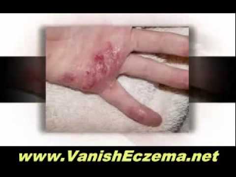how to get rid of eczema forever