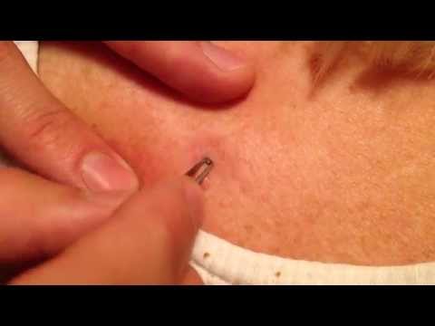 zit - Grandma's black zit. Its got itself in the little hole on her back. that thing stinks.