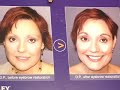 Dave Hill at the Body Beautiful Expo: Hair Transplants